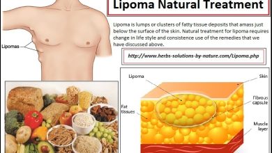 Things You Need to Know About Lipoma Natural Treatment