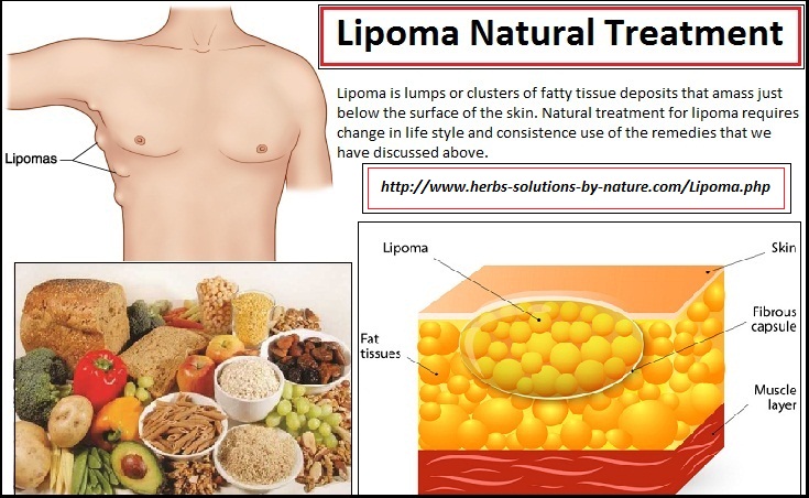 Things You Need to Know About Lipoma Natural Treatment