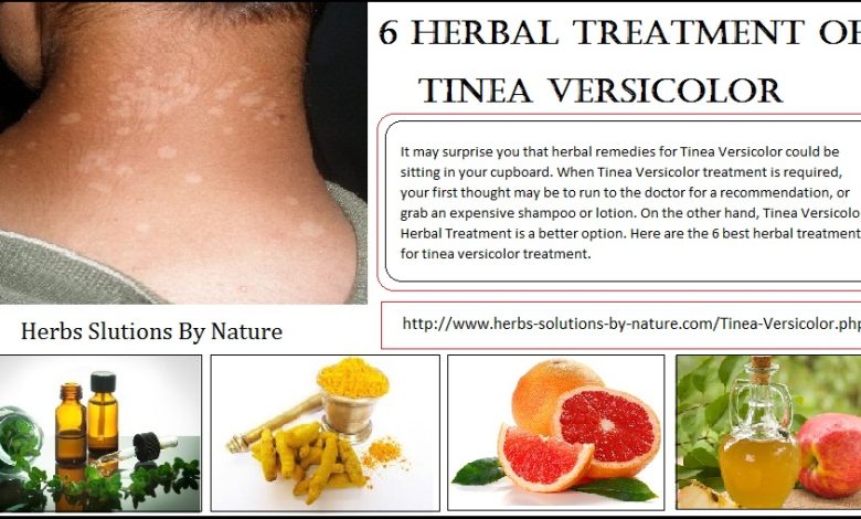 6 Herbal Treatment of Tinea Versicolor