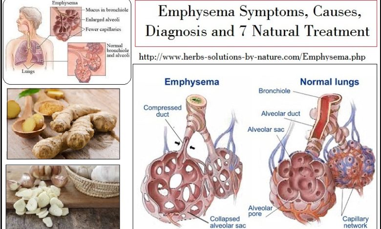 Exclusive Information about Emphysema Symptoms, Causes Diagnosis and Natural Treatment
