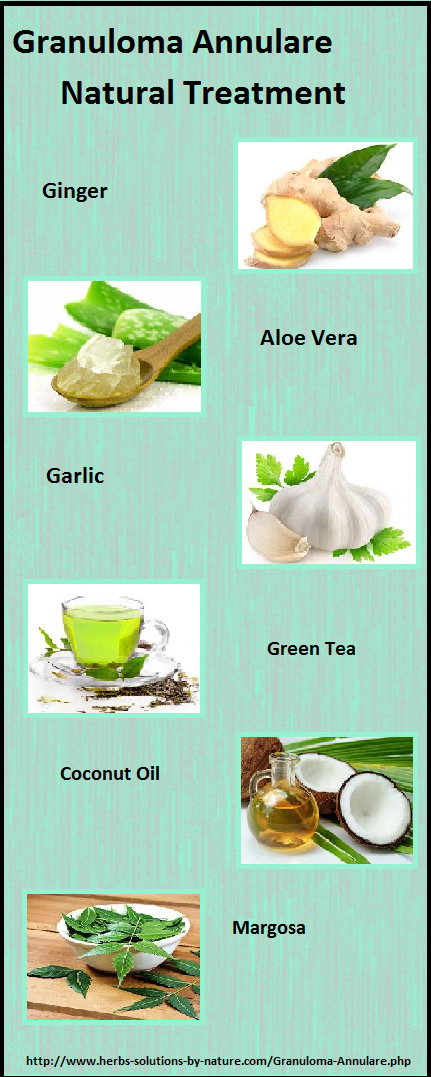 Granuloma Annulare natural treatment Archives - Herbs Solutions By Nature