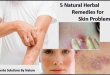 5 Natural Herbal Remedies for Skin Problems