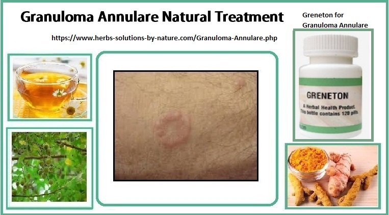 Greneton Herbal Supplement for Granuloma Annulare Natural Treatment
