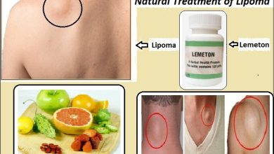 Lemeton Herbal Supplement for Natural Treatment of Lipoma