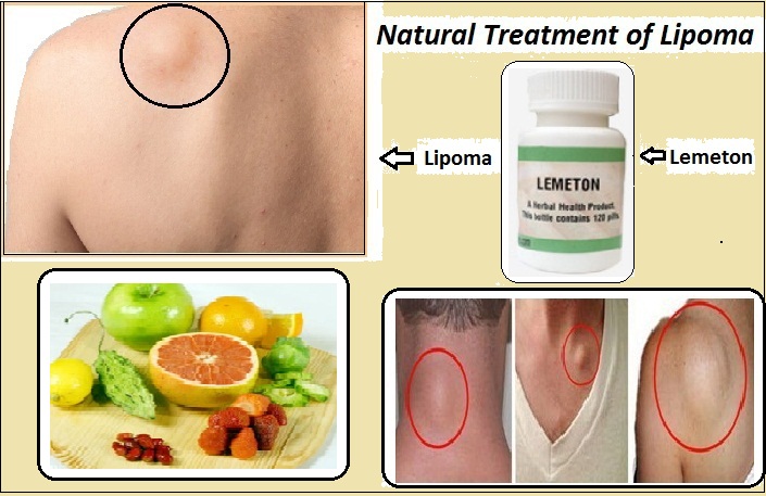 Lemeton Herbal Supplement for Natural Treatment of Lipoma