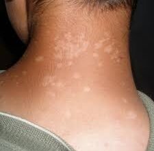 Tinea-Versicolor