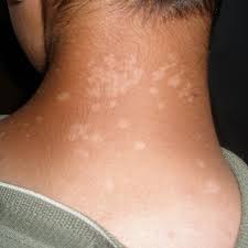 Tinea-Versicolor