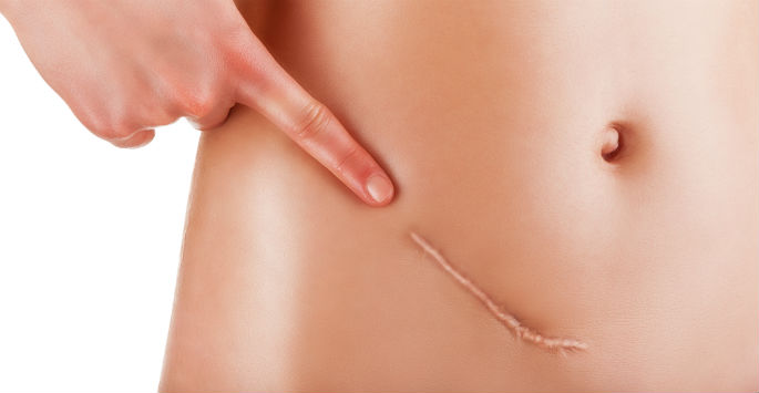 Keloids-Herbal-Treatment