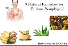 8 Natural Remedies for Bullous Pemphigoid