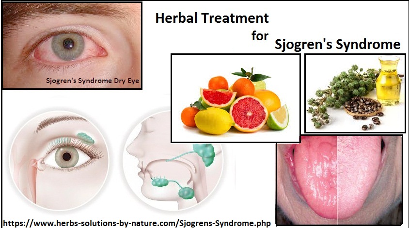 Herbal Treatment for Sjogren's Syndrome Dry Mouth and Eye