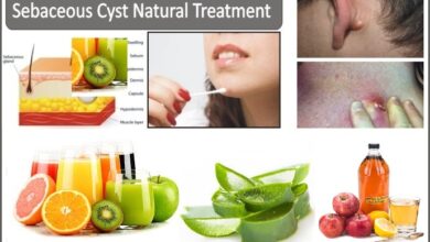 Sebaceous-Cyst-Natural-Treatment,