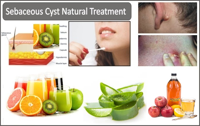 Sebaceous-Cyst-Natural-Treatment,