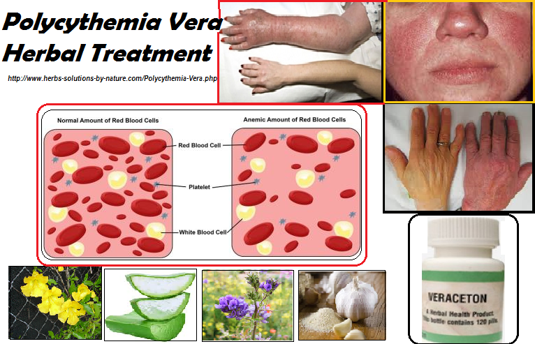 polycythemia vera