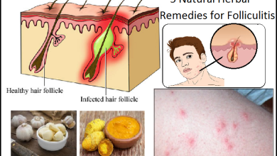 5 Natural Herbal Remedies for Folliculitis