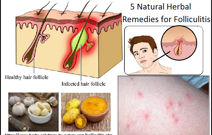 5 Natural Herbal Remedies for Folliculitis