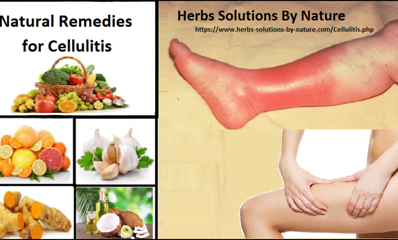 Natural Herbal Remedies for Cellulitis