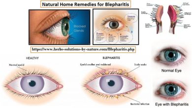 Natural Home Remedies for Blepharitis