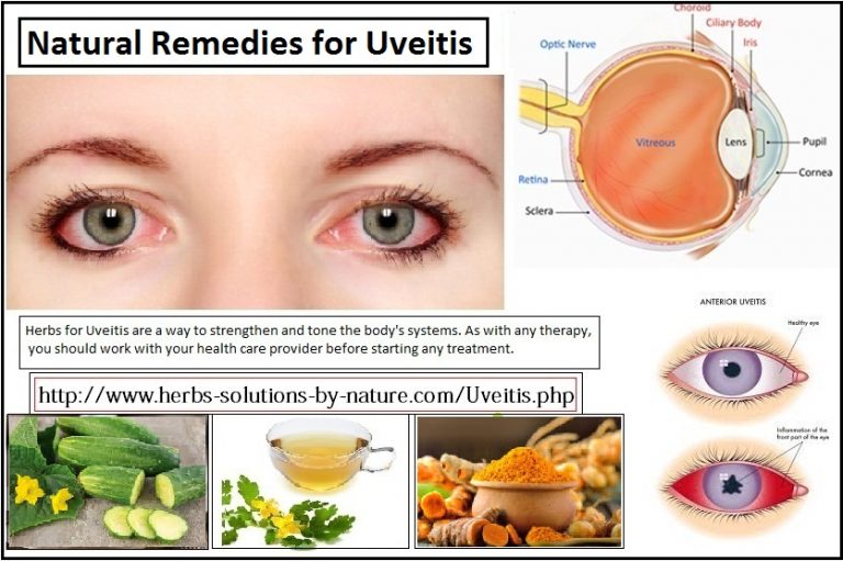 Natural Home Remedies for Uveitis Herbs Solutions By Nature Blog
