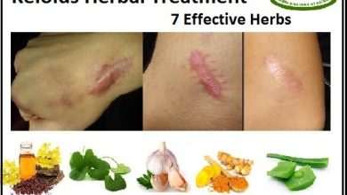 Natural Herbal Treatment for Keloids