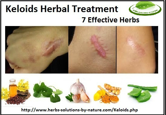 Natural Herbal Treatment for Keloids