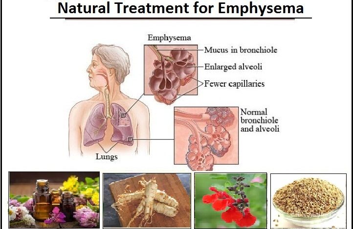 Natural Treatment for Emphysema, Herbs and Natural Essential Oils