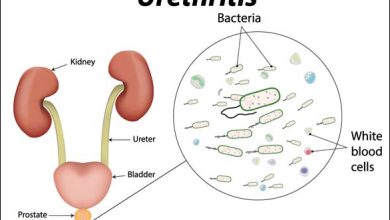 urethritis 1