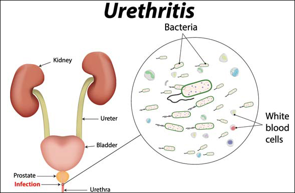 urethritis 1