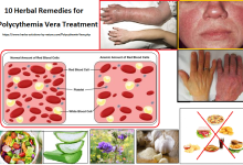 10 Herbal Remedies for Polycythemia Vera Treatment