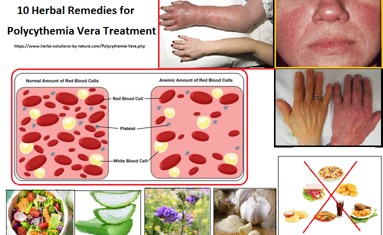 10 Herbal Remedies for Polycythemia Vera Treatment