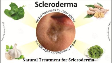 10 Best Home Remedies for Scleroderma