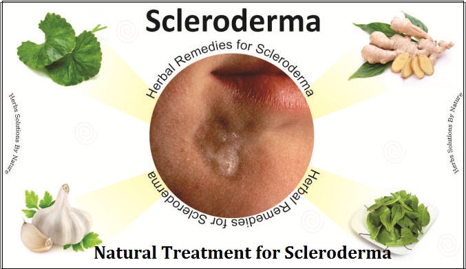 10 Best Home Remedies for Scleroderma