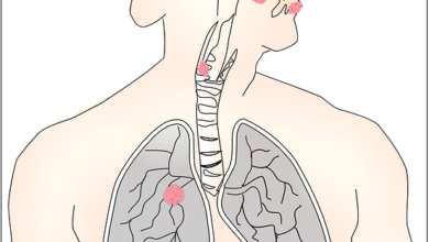 Achalasia-Natural-Treatment