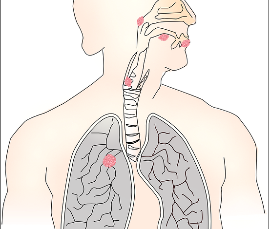 Achalasia-Natural-Treatment