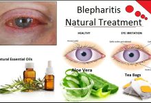 How to Get Rid of Blepharitis with Natural Remedies