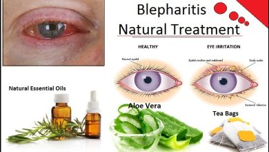 How to Get Rid of Blepharitis with Natural Remedies