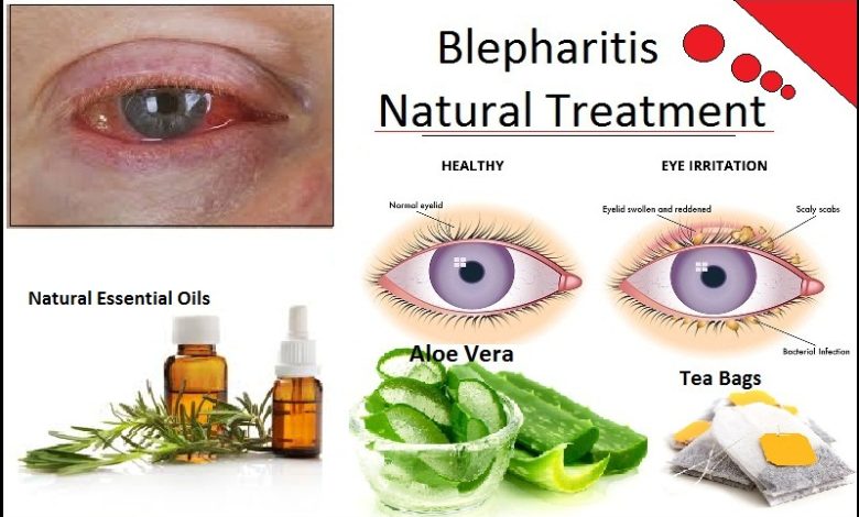 How to Get Rid of Blepharitis with Natural Remedies