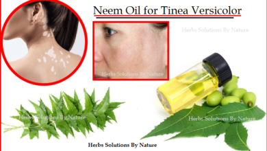 Herbal-Treatment-for-Tinea-Versicolor