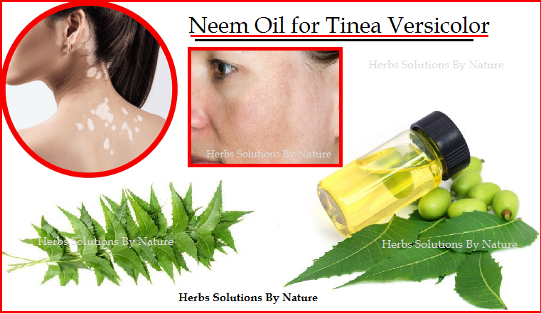 Herbal-Treatment-for-Tinea-Versicolor