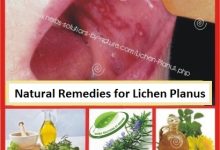 Herbal-Treatment-for-Lichen-Planus
