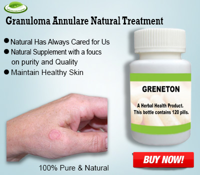 Granuloma Annulare Treat Within a Few Months with Natural Remedies