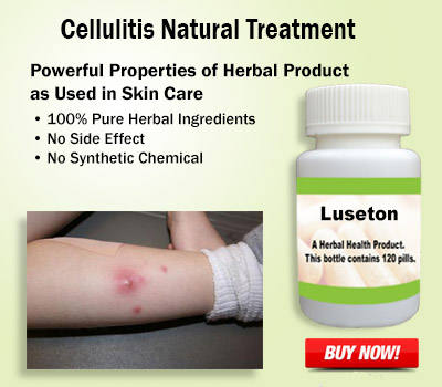 8 Best Herbal Supplements and Natural Treatment for Cellulitis