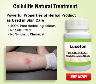 Natural Treatment for Cellulitis