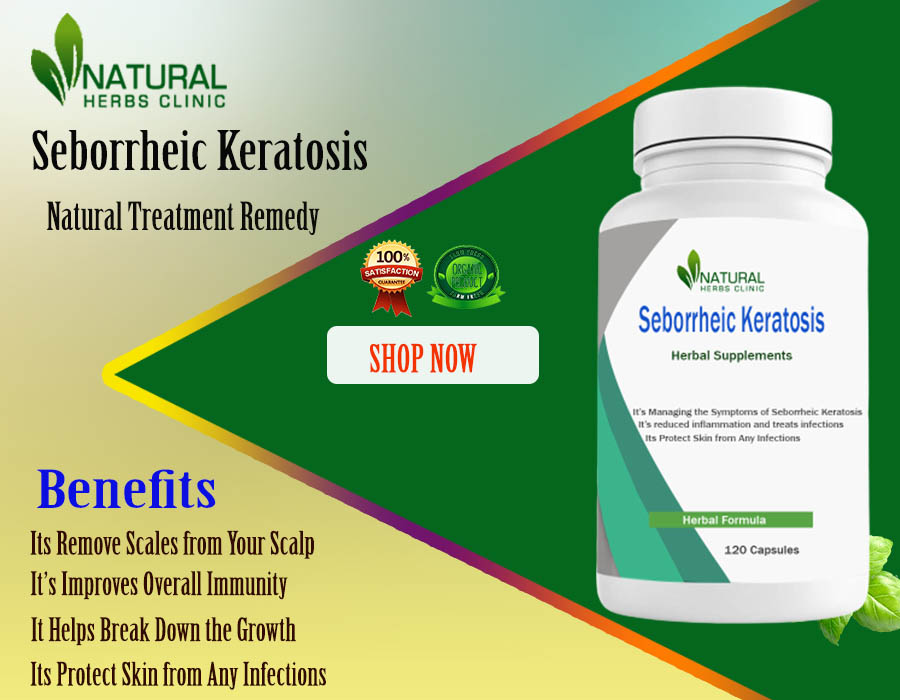 Seborrheic Keratosis Home Remedies