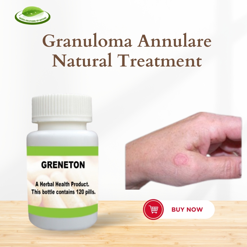  Try Natural Treatment to Treat Granuloma Annulare Naturally