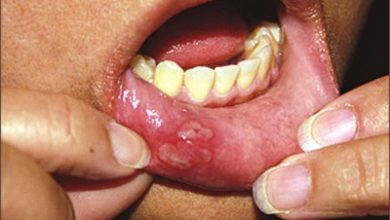 oral-lichen-planus