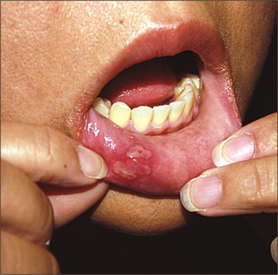 oral-lichen-planus