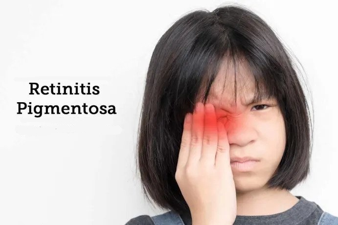 Retinitis Pigmentosa Treatment 2023