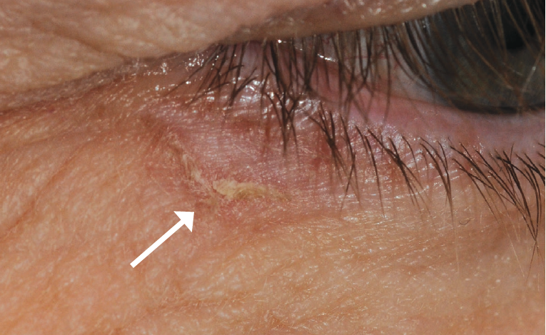 Actinic Keratosis Eyelid