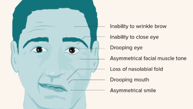 Bell's Palsy Eye Treatment