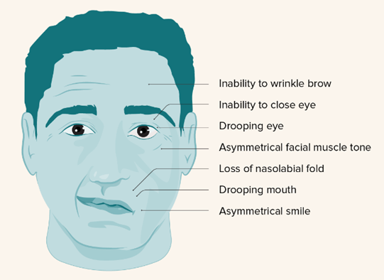 Bell's Palsy Eye Treatment